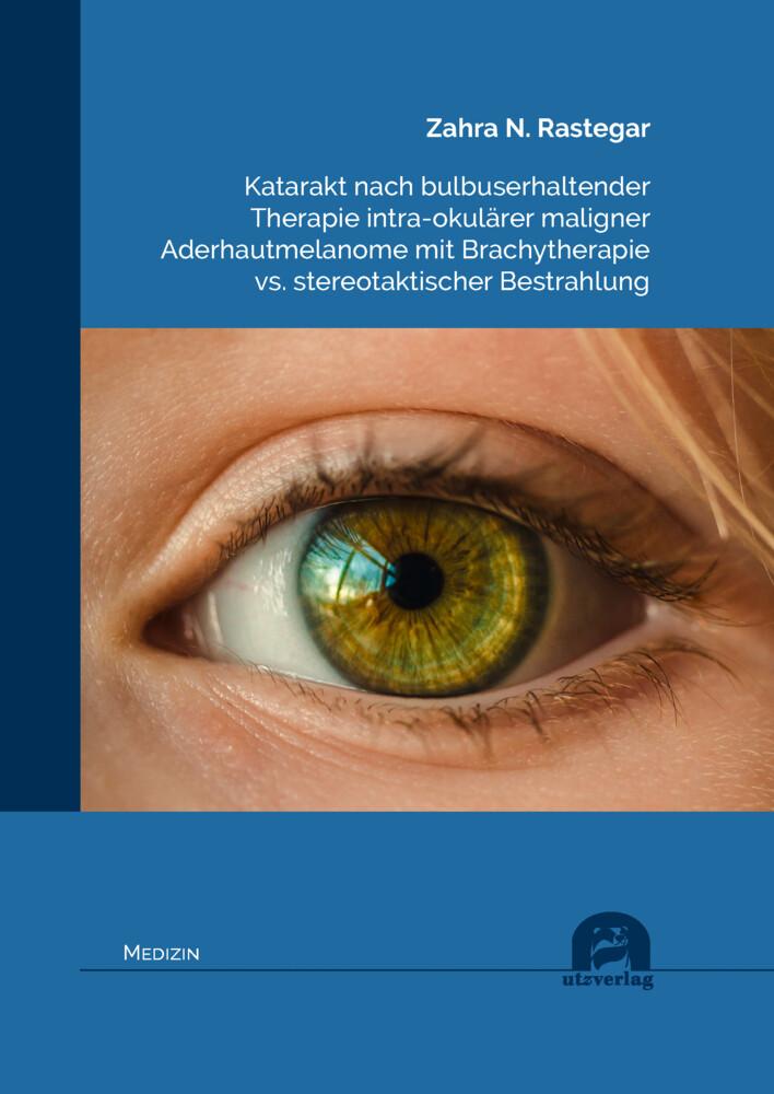 Katarakt nach bulbuserhaltender Therapie intra-okulärer maligner Aderhautmelanome mit Brachytherapie